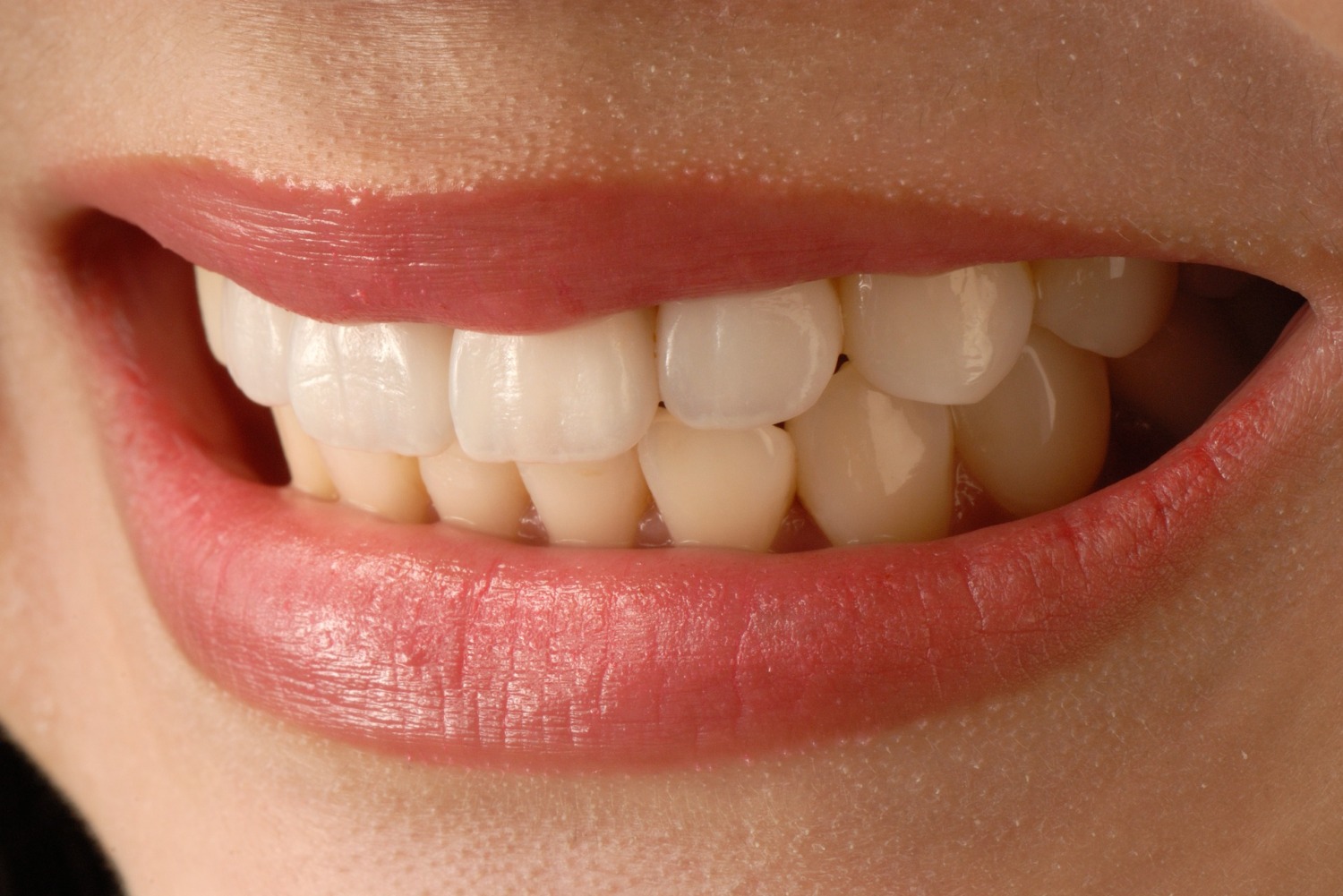 👏牙齿矫正，你需要知道这些！各种牙型对照！牙齿矫正_圈子-新氧美容整形